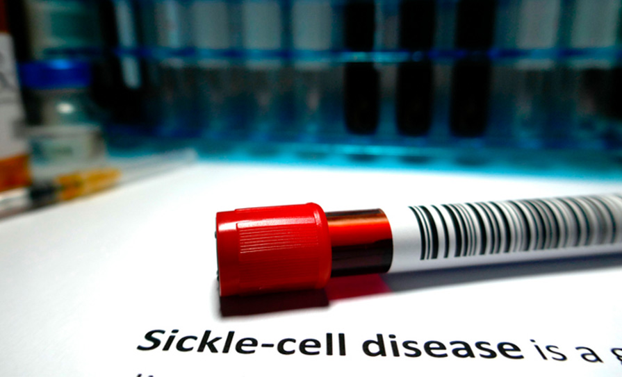 sickle cell