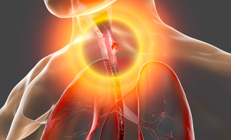 oesophageal cancer