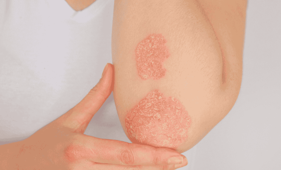 Psoriasis in primary care