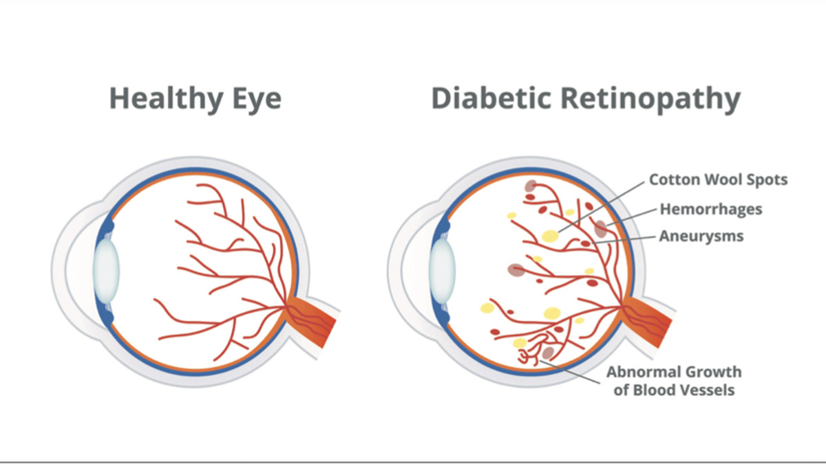 Diabetic retinopathy