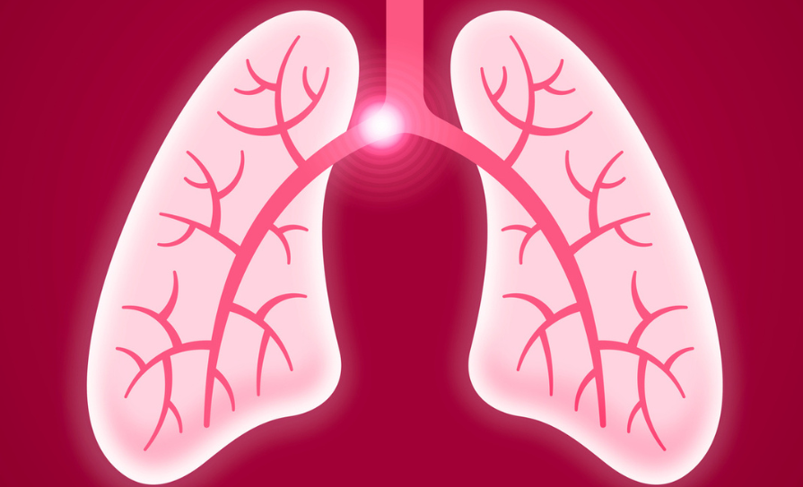 pulmonary embolism