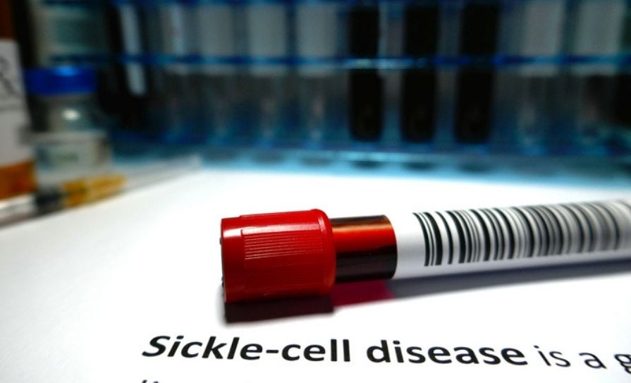 sickle-cell disease