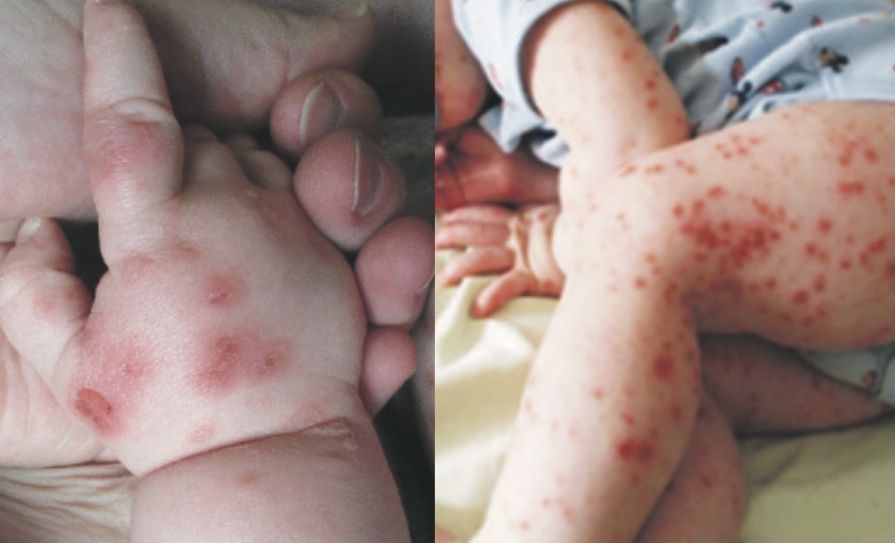 hand foot and mouth disease