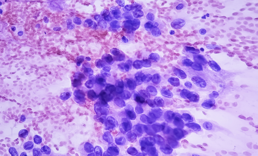 pulmonary nodule screening